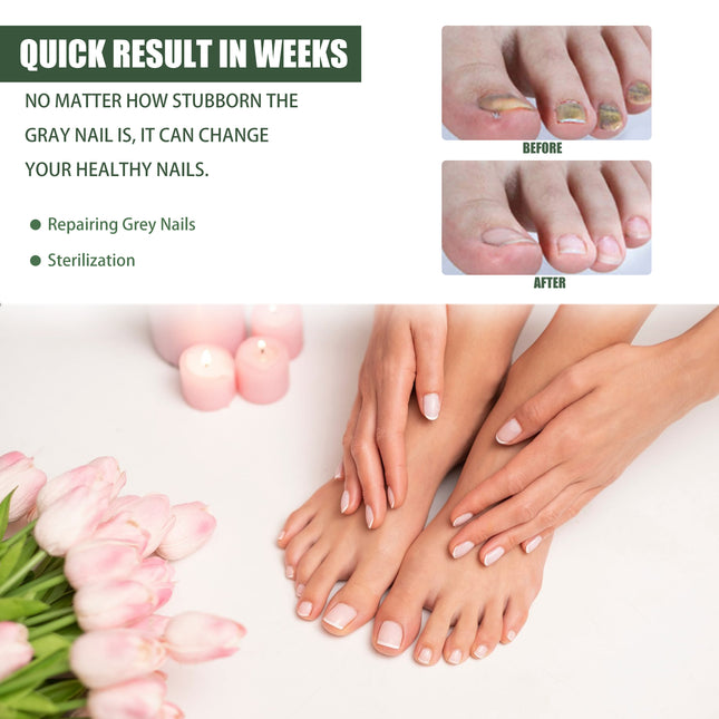 South Moon Toenail Repair Set, Gray Nail Cleaning And Brightening Nails, Hand And Foot Thickening Gray Nail Repair Set