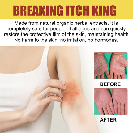 South Moon Breaking Itch King, Relieve Hand And Foot Moss Skin Moss Redness Repair Skin Itching Skin Care Cream
