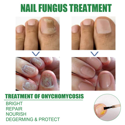 EELHOE Nail Repair Solution Tea Tree Oil Essence Gentle Nourishing Manicure Cleansing Soft Nail Care Solution