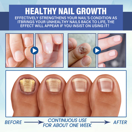 EELHOE Nail Repair Led Light Therapy Device, Hand And Foot Nails Yellow Soft Nail Repair Thickening Smooth Nail Surface