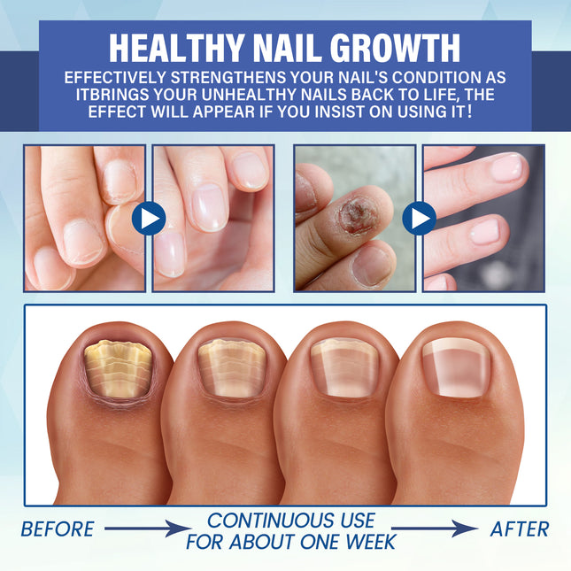 EELHOE Nail Repair Led Light Therapy Device, Hand And Foot Nails Yellow Soft Nail Repair Thickening Smooth Nail Surface