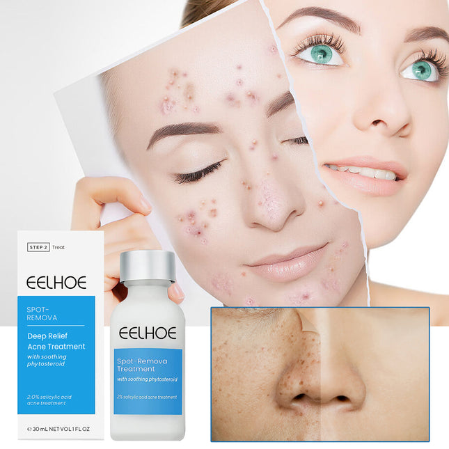 EELHOE Blemish Smoothing Lotion, Reduce Closed Mouth Acne Acne Spot Removal Repair Skin Lotion