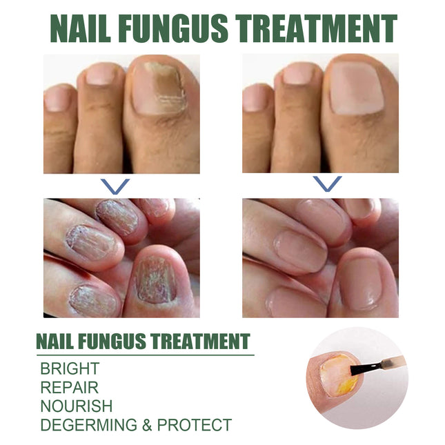 EELHOE Nail Care Liquid (30ml) Gentle Cleaning, Hydrating And Moisturizing Liquid For Thick And Soft Nails On The Surface Of Hands And Feet