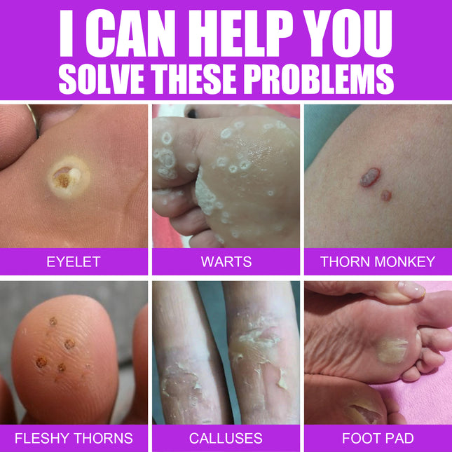 South Moon Remove Chicken Eye Lotion Extra Clear Remove Corns Skin Care Chicken Calluses Foot Pad Gram Warts