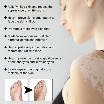 EELHOE Vitiligo Removal Relief Spray, Repair Whitening Spot Perspiration Beauty Moisturizing Skin Care spray