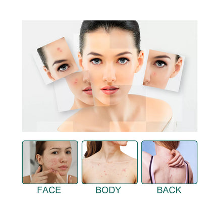 EELHOE Star Acne Patch Gentle Cleansing Lighten Acne Soothing Skin Acne Patch Facial Cleansing Treatment