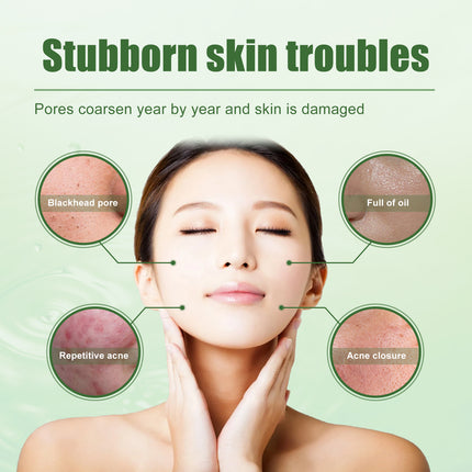 South Moon Acne Removing Gel, To Acne Silent Desalt Blain To Imprint Improve Blain Pit Muscle Clean Bright Skin