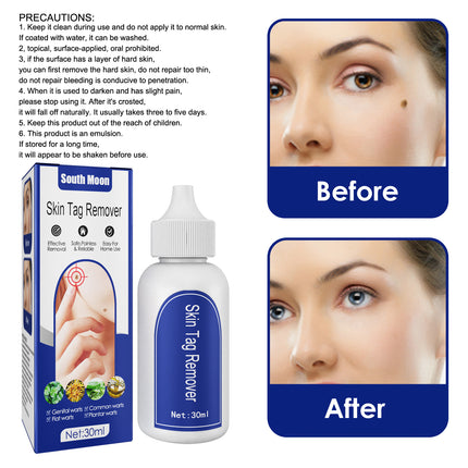 South Moon Warts Biconk Wart Liquid, Remove Flat Especially Face Eye Remove Ordinary Flat Especially