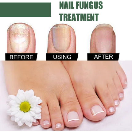 EELHOE Nail Care Liquid (30ml) Gentle Cleaning, Hydrating And Moisturizing Liquid For Thick And Soft Nails On The Surface Of Hands And Feet
