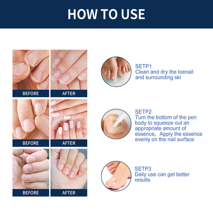 Nail Repair Relieve Essence Pen, Moisturizing Repair Hand And Foot Inlay Nail Thickening Grey Nail Correction Pen