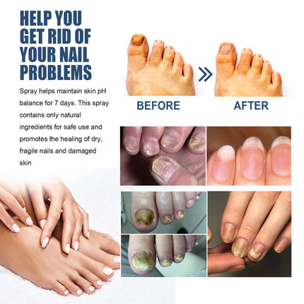 Nail Care Spray Gently Cleans Foot Nails Moisturizing And Brightening Nail Care Spray