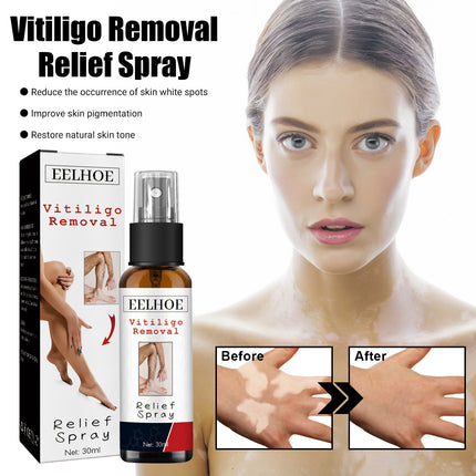 EELHOE Vitiligo Removal Relief Spray, Repair Whitening Spot Perspiration Beauty Moisturizing Skin Care spray