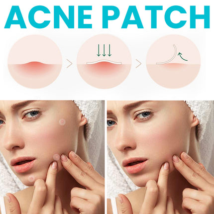 OUHOE Acne Patch, Repair Facial Acne Invisible Concealer Hydrocolloid Patch