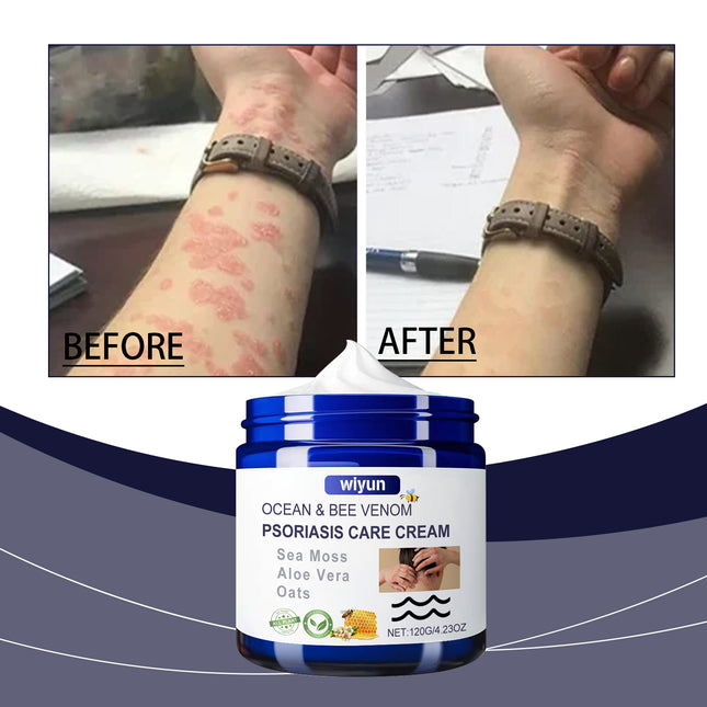 Wiyun Bee Venom Skin Care Cream, Repair Red And Itchy Skin Moisturizing Skin Cool And Anti-Itchy Care Cream