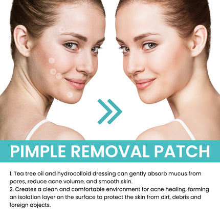 West&Month Acne Patch (240pcs) Repairs Acne And Blackheads, Cleans Pores, Is Invisible, Breathable, Concealer And Waterproof