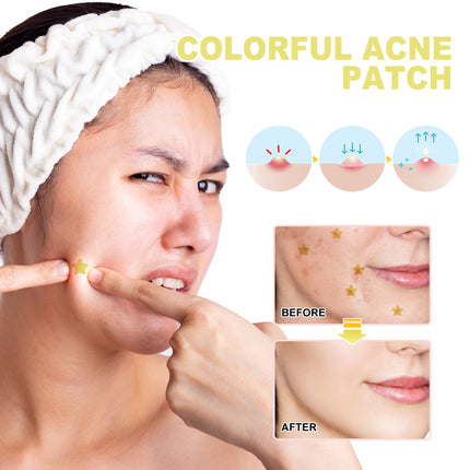 Yellow Acne Patch Mild Ingredients Moisturize, Moisturize, Cleanse And Care For Facial Acne Patches