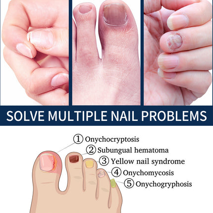 Nail Repair Relieve Essence Pen, Moisturizing Repair Hand And Foot Inlay Nail Thickening Grey Nail Correction Pen