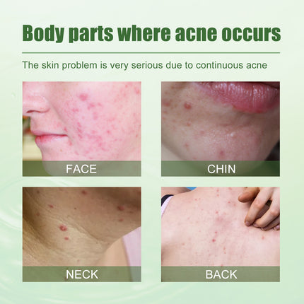 South Moon Acne Removing Gel, To Acne Silent Desalt Blain To Imprint Improve Blain Pit Muscle Clean Bright Skin