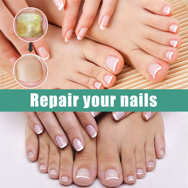 EELHOE Herbaceous Nail Relief Essence, Hand And Foot Nail Soft Thickening Brightening Nail And Bump Nail Care Solution
