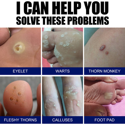 South Moon Warts Biconk Wart Liquid, Remove Flat Especially Face Eye Remove Ordinary Flat Especially