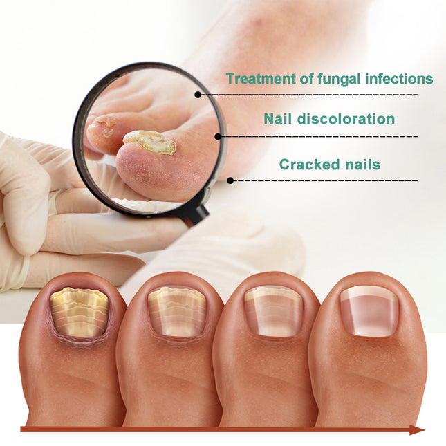 EELHOE Herbaceous Nail Relief Essence, Hand And Foot Nail Soft Thickening Brightening Nail And Bump Nail Care Solution